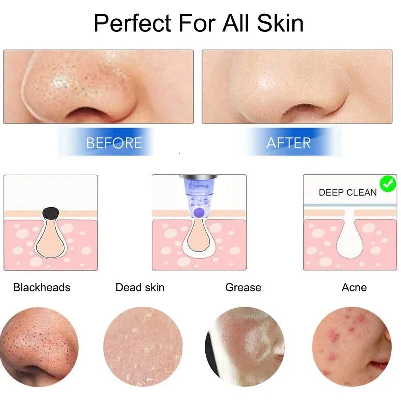 Blackhead Remover Vacuum Suction Pore Cleaner Acne Comedone Whitehead Extractor Face Nose T Zone Spot Cleaner USB Rechargeable